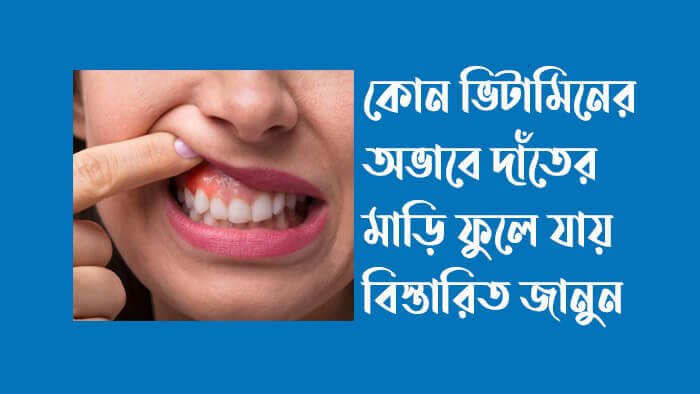 কোন-ভিটামিনের-অভাবে-দাঁতের-মাড়ি-ফুলে-যায়